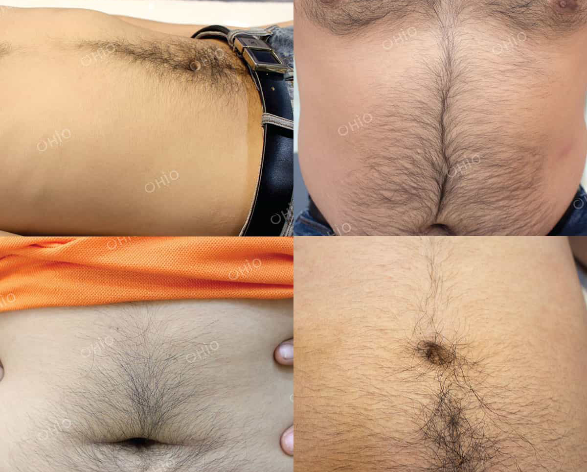 Triệt Lông Bụng Tại Sen Beauty